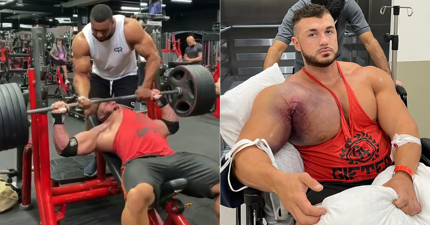 Graphic Content: Bodybuilder Ryan Crowley Suffers Devastating Bench Press Injury